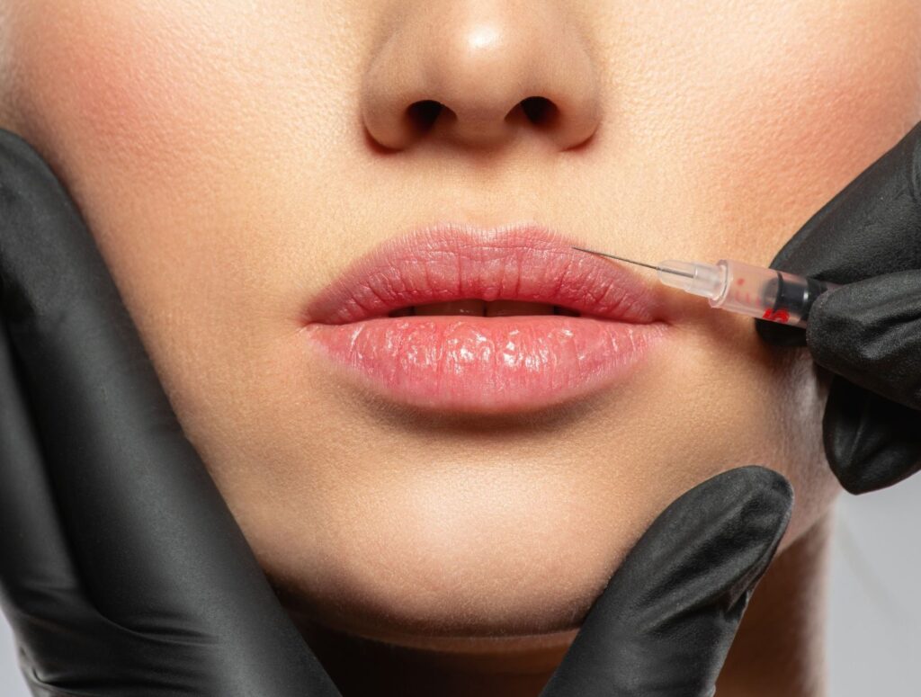 injection acide hyaluronique lèvres montpellier