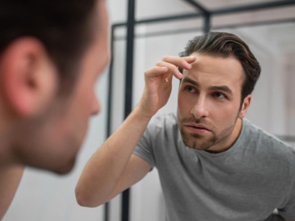 perte de cheveux homme